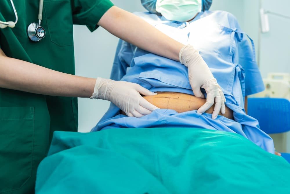 Plicatura de rectos abdominales por diástasis de rectos en Puebla: cirugía para corregir la separación de los músculos abdominales